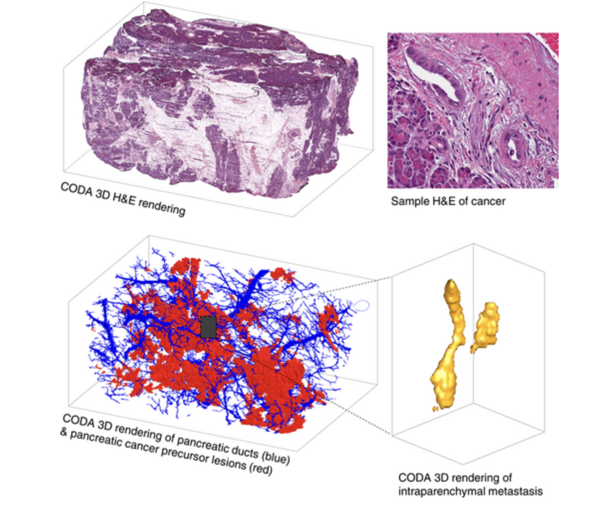 intraparenchymal.png